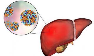 乙型肝炎的早期症状 乙肝发病症状初期表现有哪些
